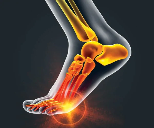 d_Showcase_Product_Detail_Module2_720x600_PR_BallFootPain.webp